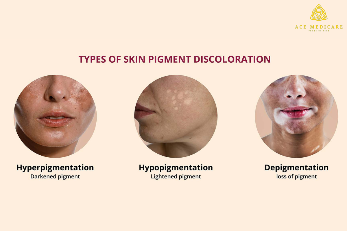 How to Care for Different Types of Skin Pigmentation